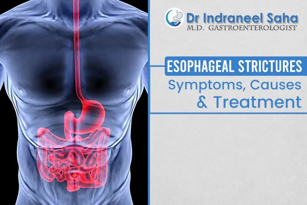 Esophageal Strictures
