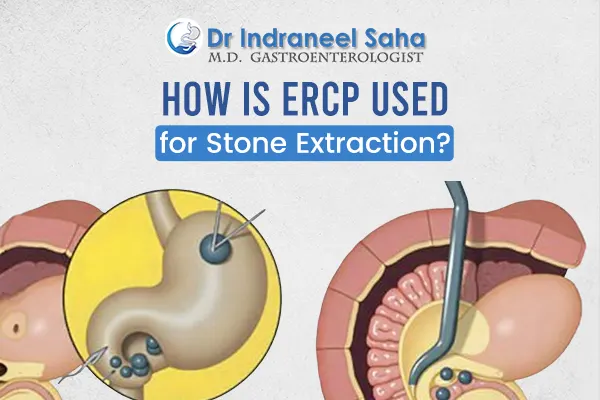 ercp stone extraction