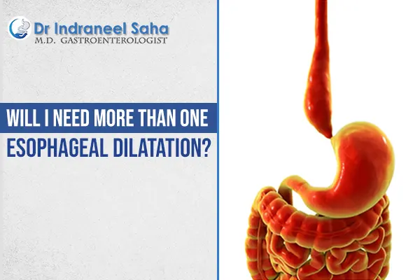 esophageal dilatation
