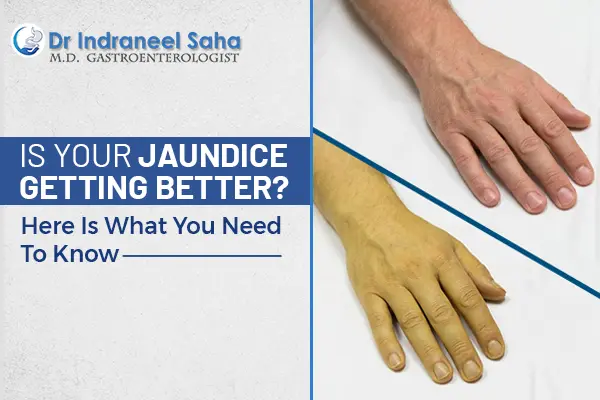 jaundice treatment doctor