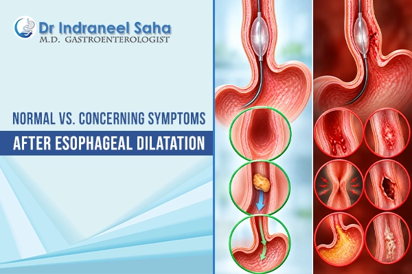 Esophageal Dilation